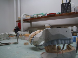 Dental bridges in Dental Laboratory 